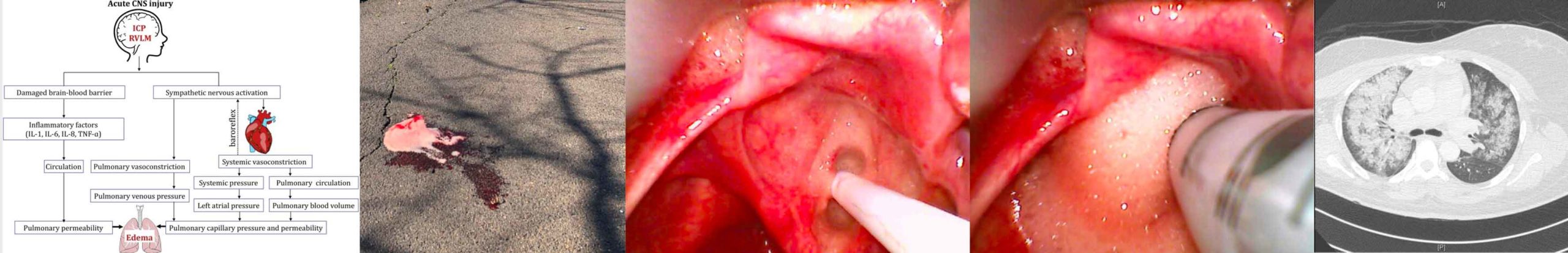 Neurogenic Pulmonary Edema Emcrit Project