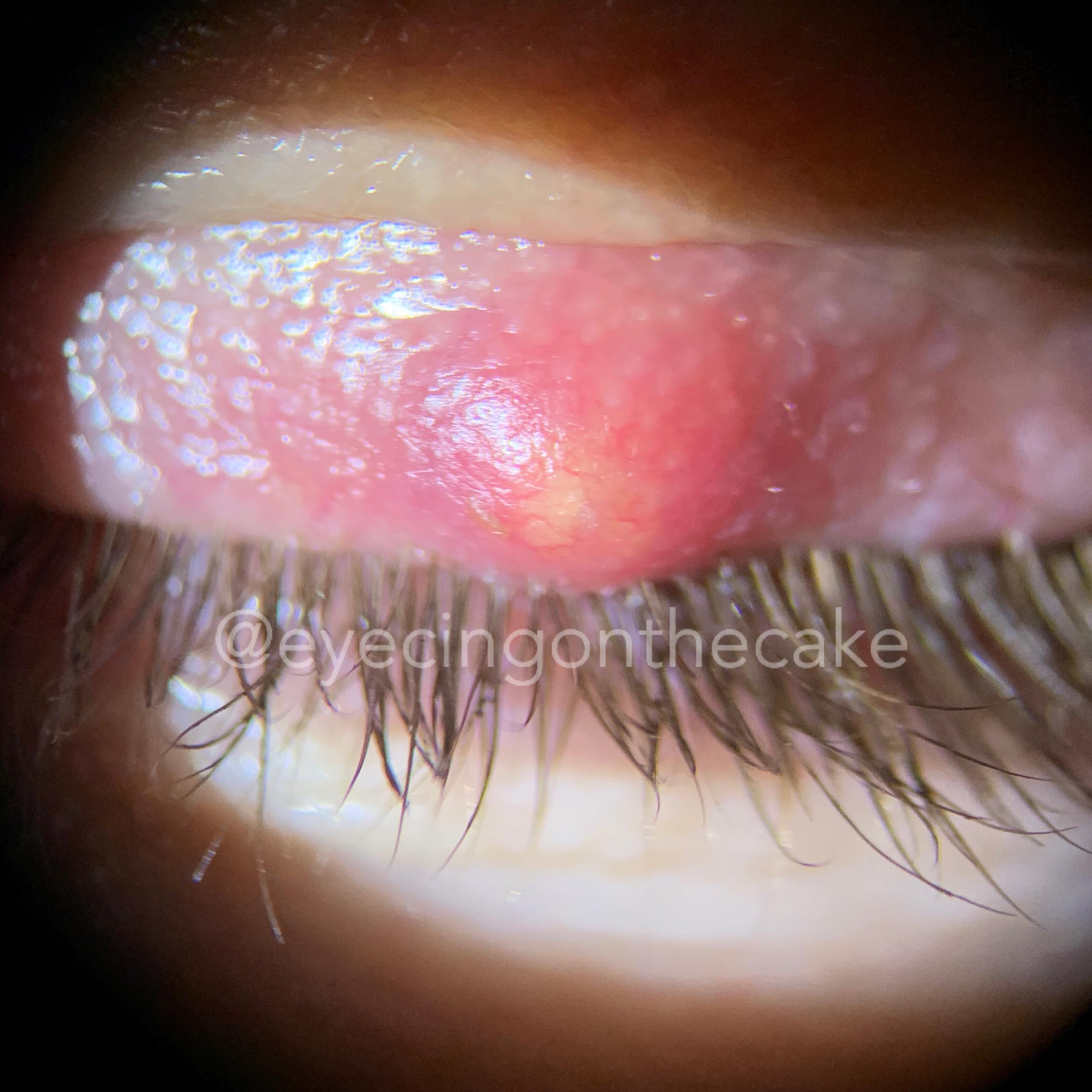 How To Get Rid Of A Stye Eyecing On The Cake