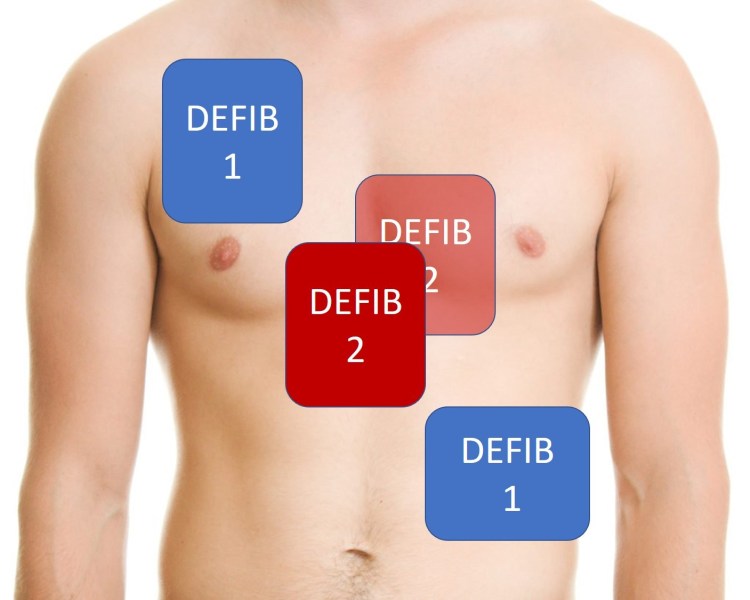 Double sequential defibrillation (The DOSE VF trial) - First10EM (1) Double sequential defibrillation (The DOSE VF trial) - First10EM (1)