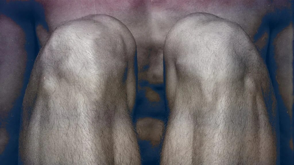 Tricompartmental osteoarthritis: What you need to know (1) Tricompartmental osteoarthritis: What you need to know (1)