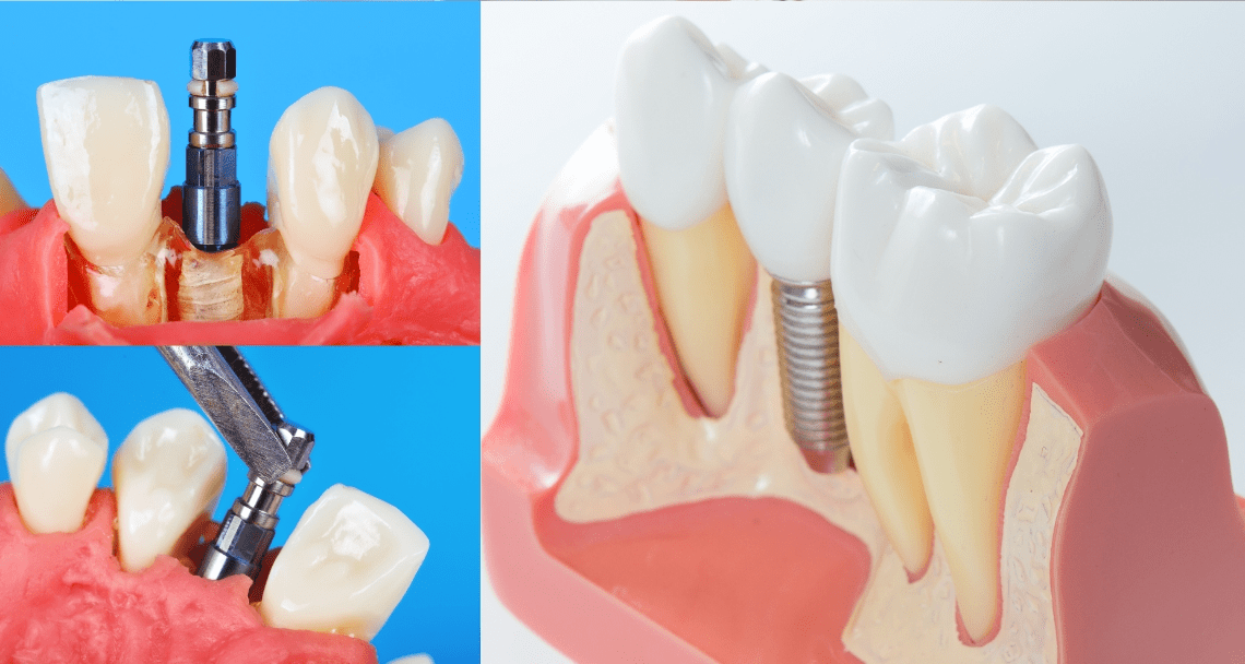 How Does One Day Dental Implant Work? | GlenBurnieDental