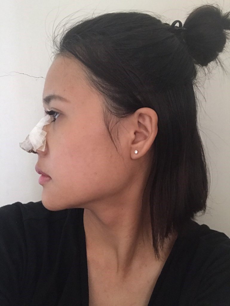 台中醫美/峻美診所-勇敢追夢with卡麥拉隆鼻，重新蛻變自我，找回自信新生感！ 民生資訊分享 醫美 