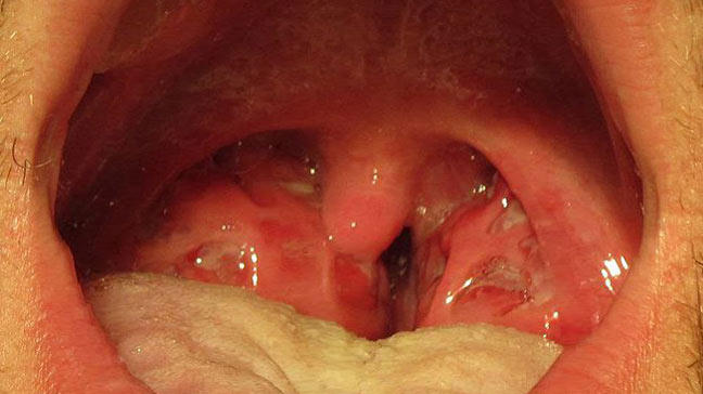 Strep Throat Symptoms Causes Treatment And More