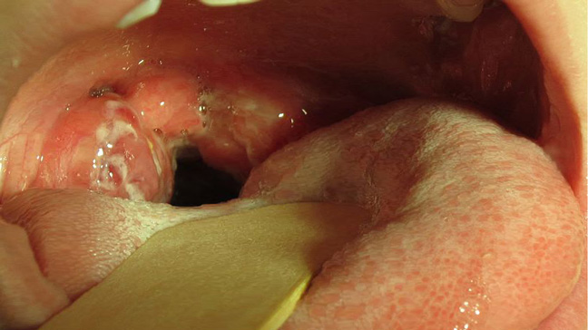 Strep Throat Symptoms Causes Treatment And More