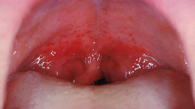 Strep Throat Symptoms Causes Treatment And More
