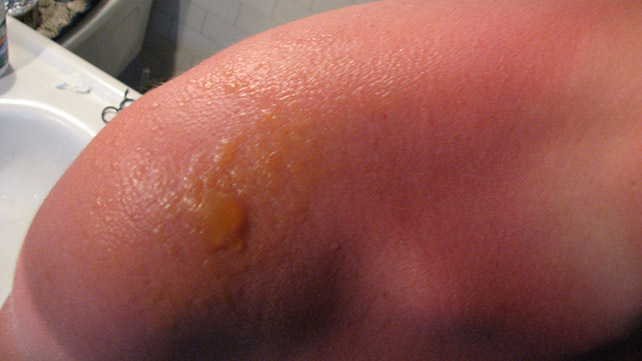 Sunburn Blisters Symptoms Treatments And Complications