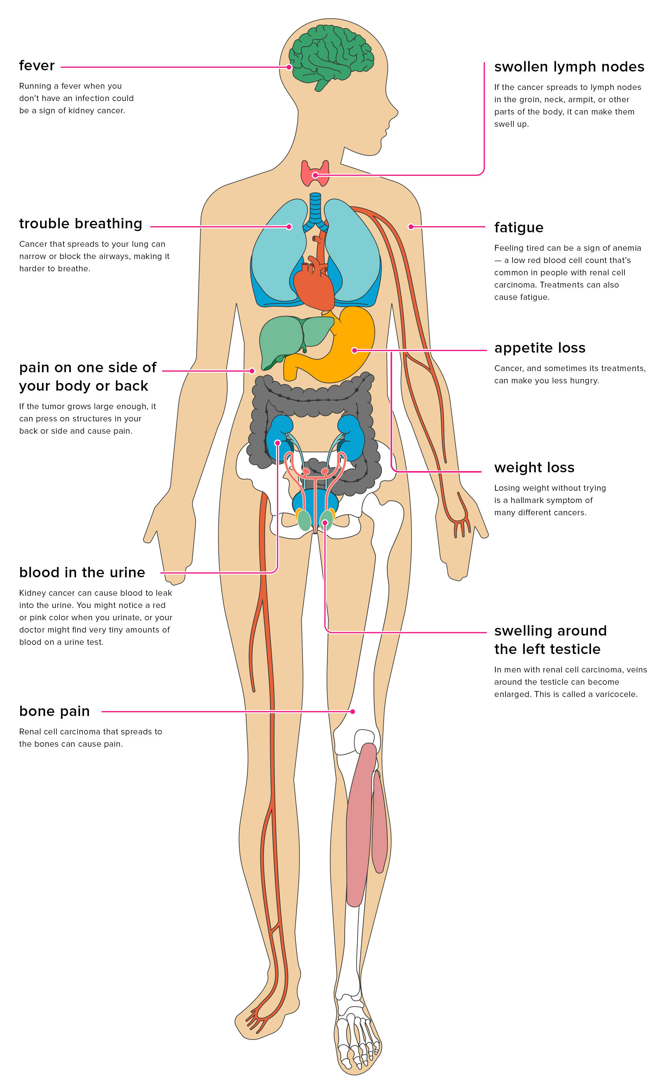 The Effects Of Metastatic Renal Cell Carcinoma On The Body