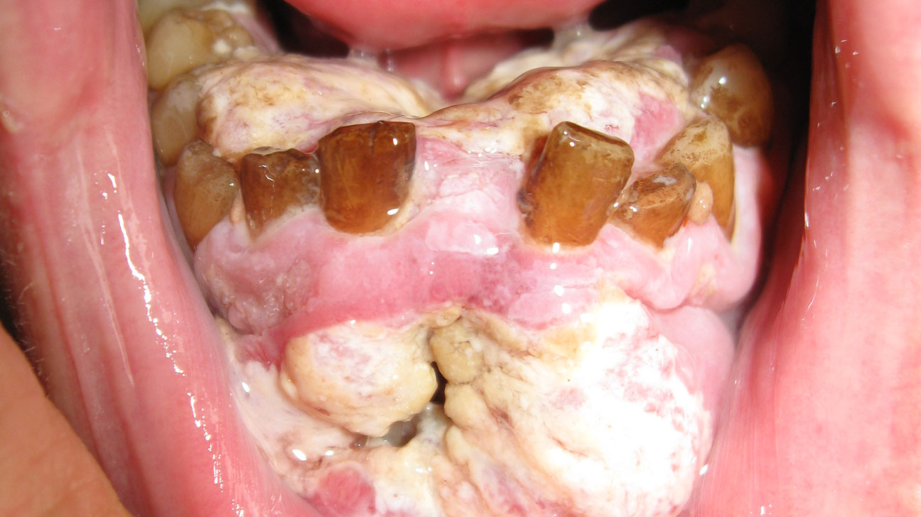 Mouth Sores Pictures Causes Types Symptoms And Treatments