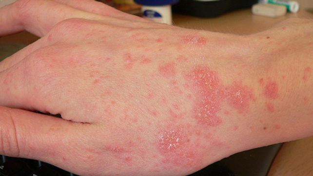 Scabies vs. Eczema: Differences, Symptoms, and Treatment