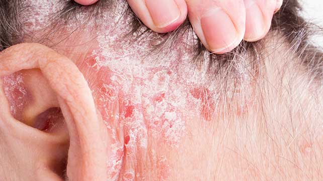 Scalp Conditions Pictures Causes And Treatments