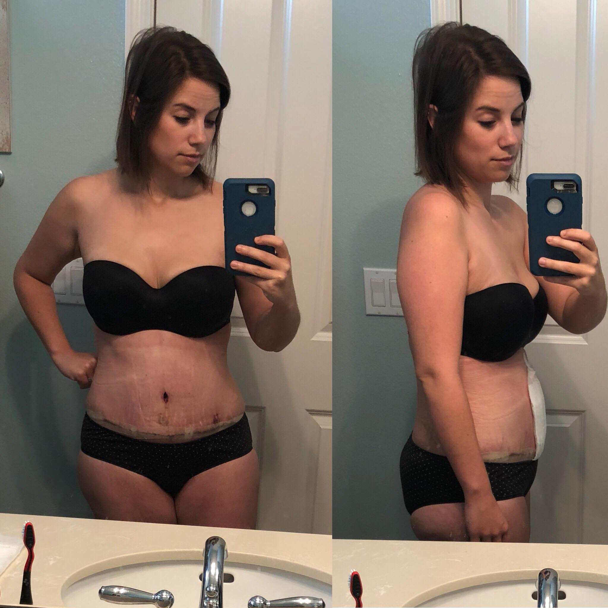 Abdominoplasty Healing Update Week 1 Instant Loss Conveniently Cook Your Way To Weight Loss