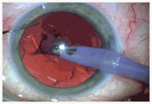 Phaco Cataract Surgery International Specialist Eye Centre Malaysia