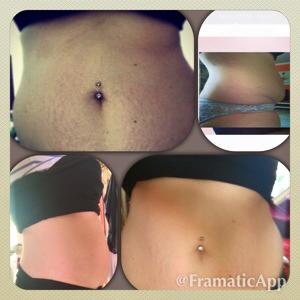 Mein Kampf Gegen Die Cellulitis Was Hilft Wirklich