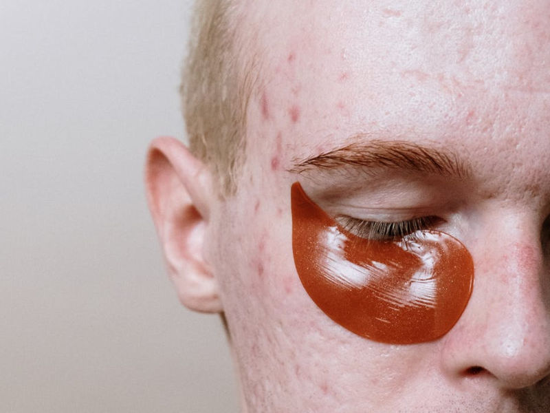 Acne Da Stress Come Riconoscerla E Curarla Lovepedia Magazine
