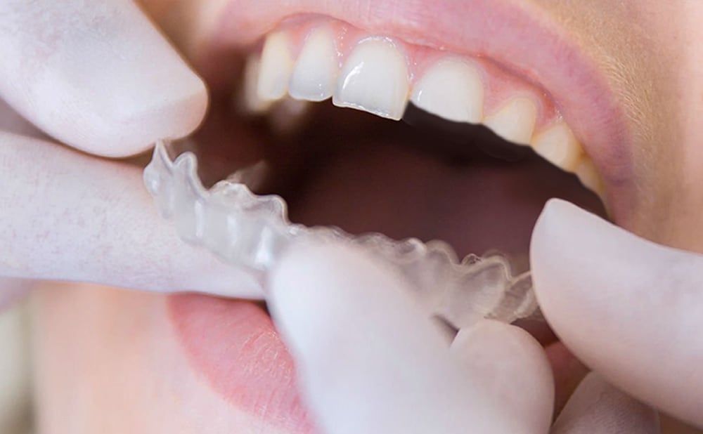 Dry Socket You Might Wonder What Is A Dry Socket Maxcare Dental