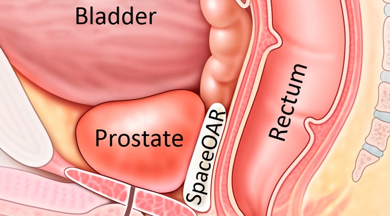 Picture used to illustrate prostrate cancer (Photo Credit: health-in-europe.com)