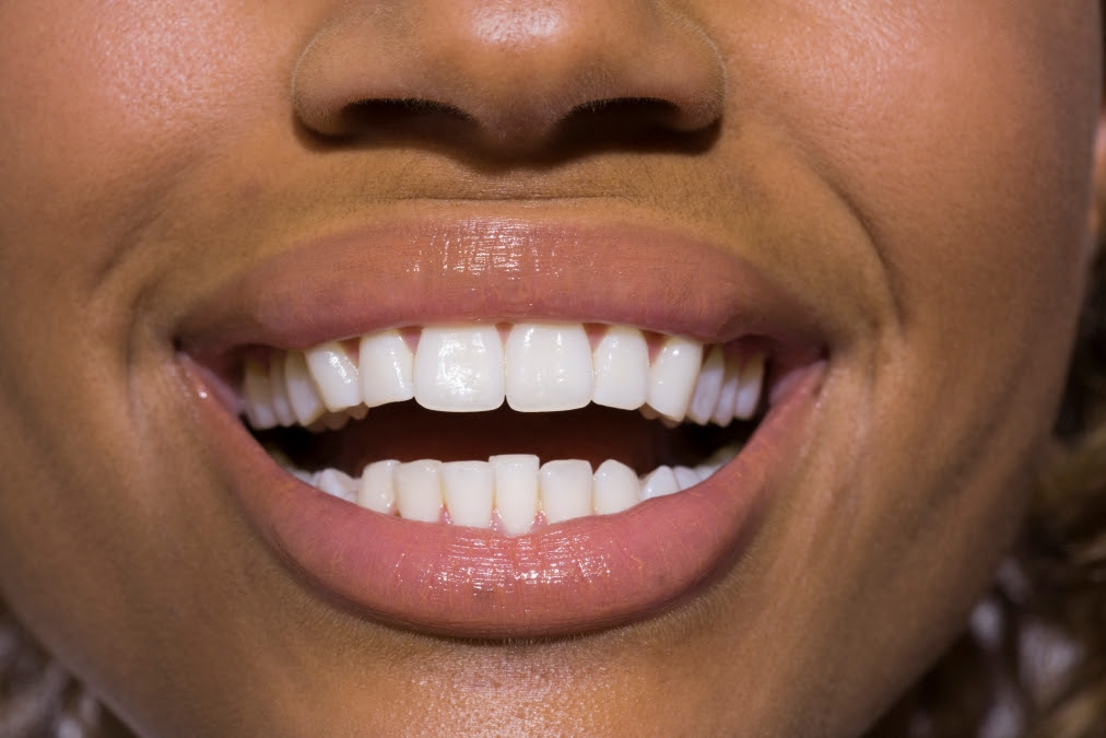 Someone's teeth used to illustrate the brushing story (Photo Credit: Tozali Online7)