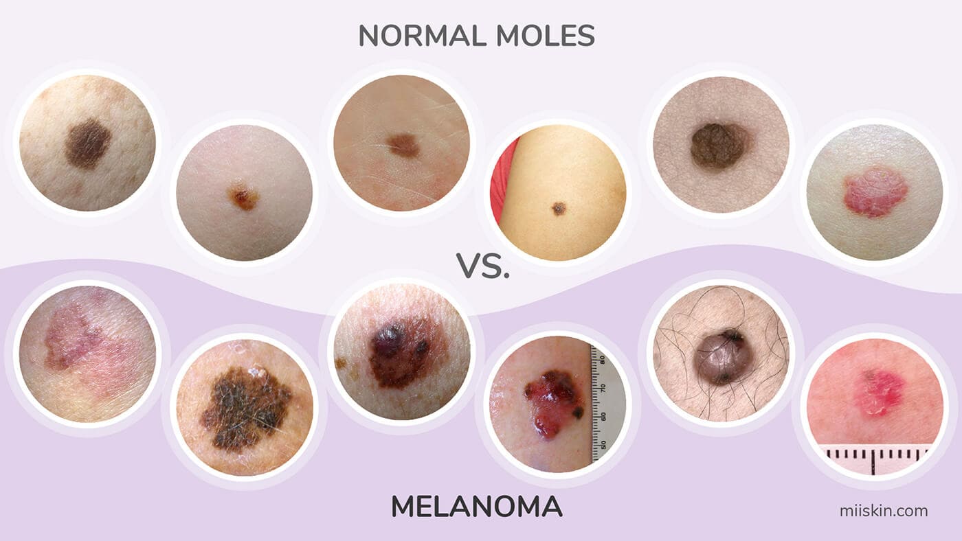 cancerous mole