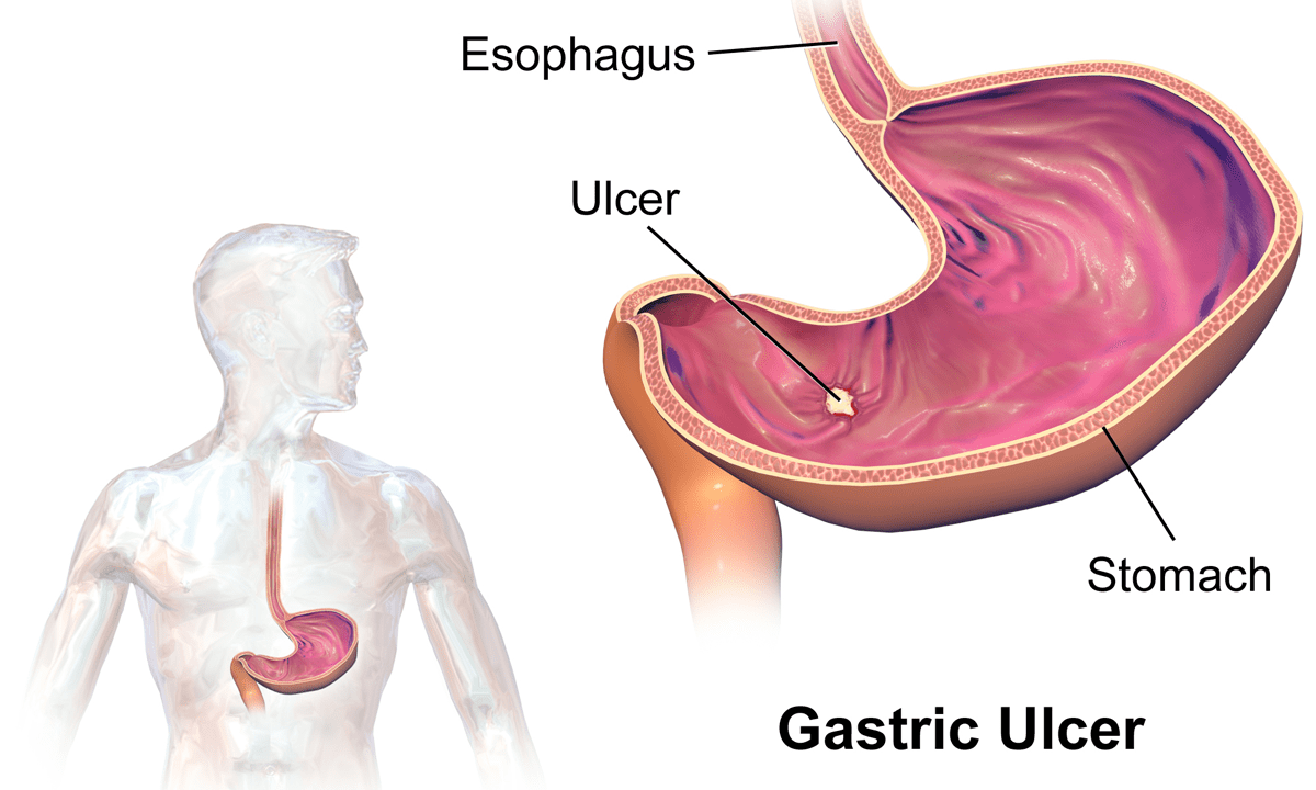 An image to illustrate gastric ulcer