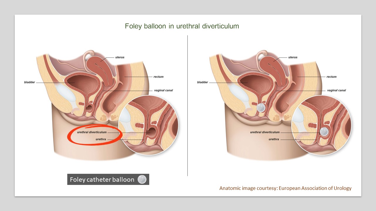Misplaced Foley Catheter In A Female Patient Nephropocus