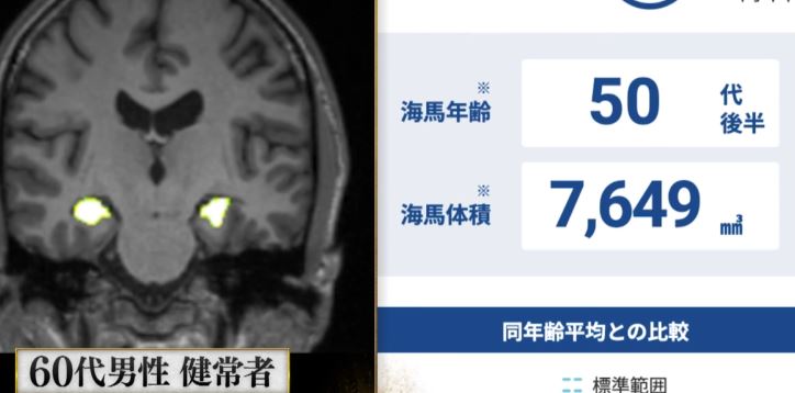 breakth-splink-aibrainhealthcare