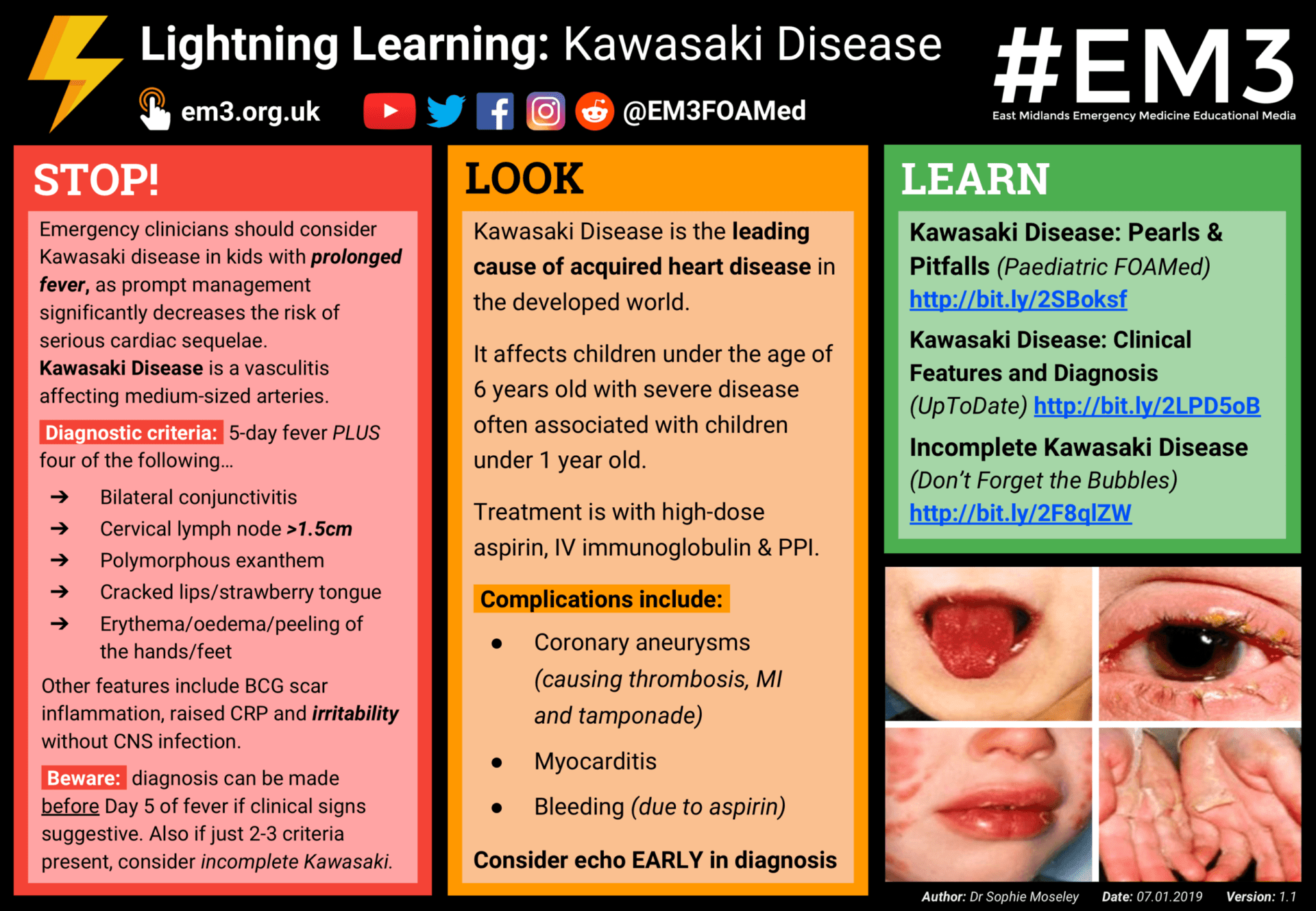 Lightning+learning+ +kawasaki+disease+(v1.1)