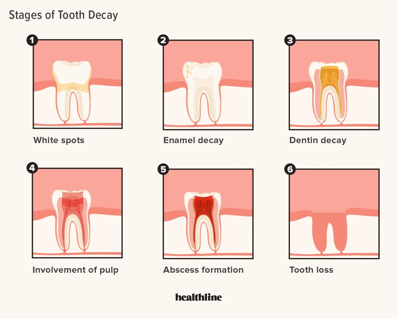 Tooth Decay Stages 5 Stages And How To Treat Each