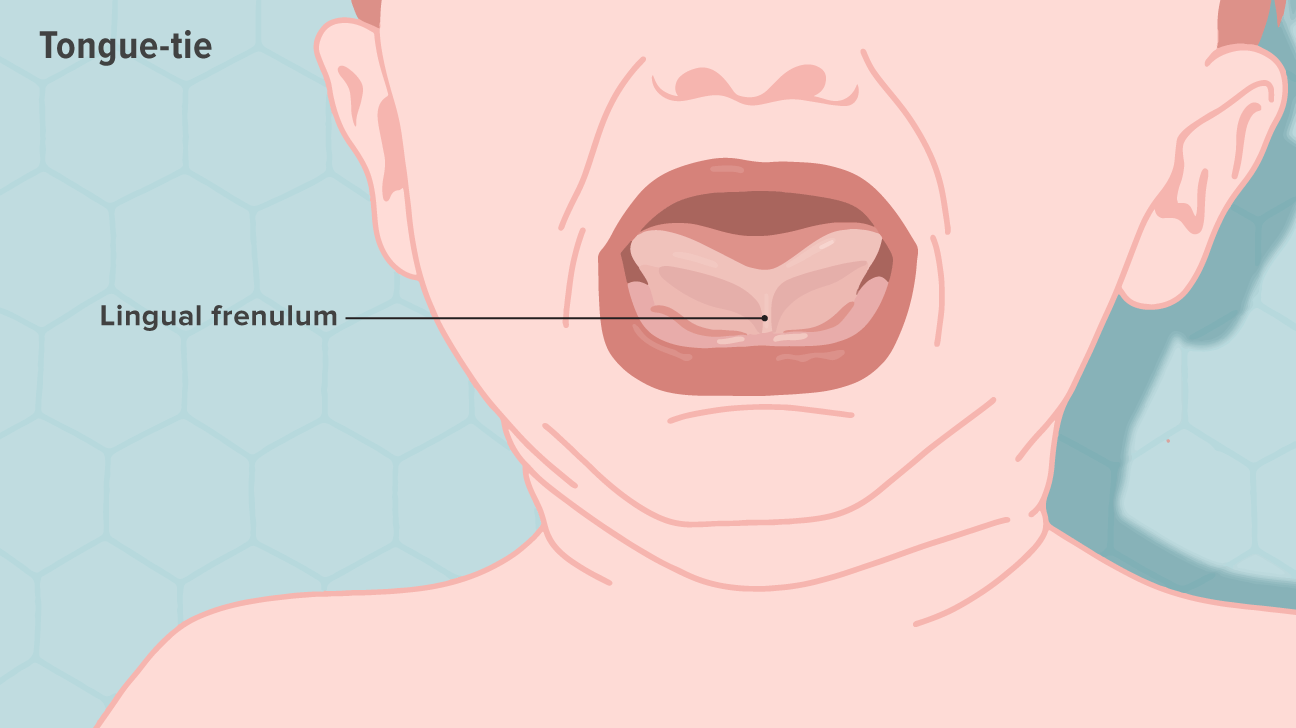 Tongue Tie What It Is And How It S Treated