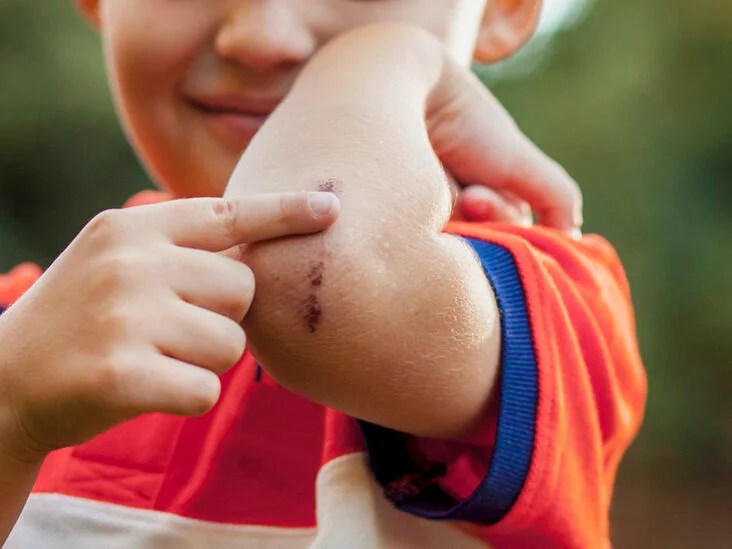 Why Do Scabs Itch Causes And Treatments