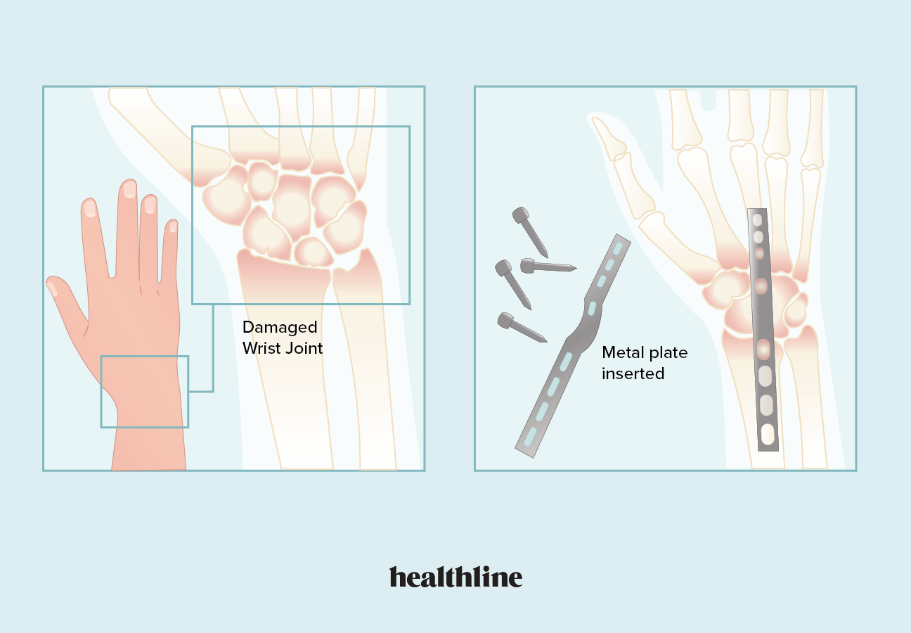 Wrist Fusion Surgery Types Benefits Risks Costs And More
