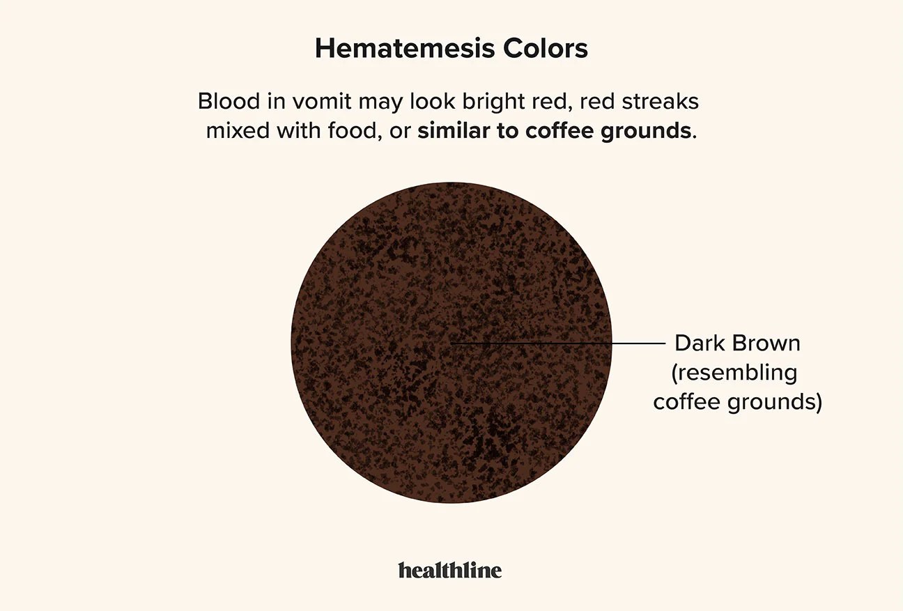 Vomiting Blood Hematemesis Causes Symptoms Treatment