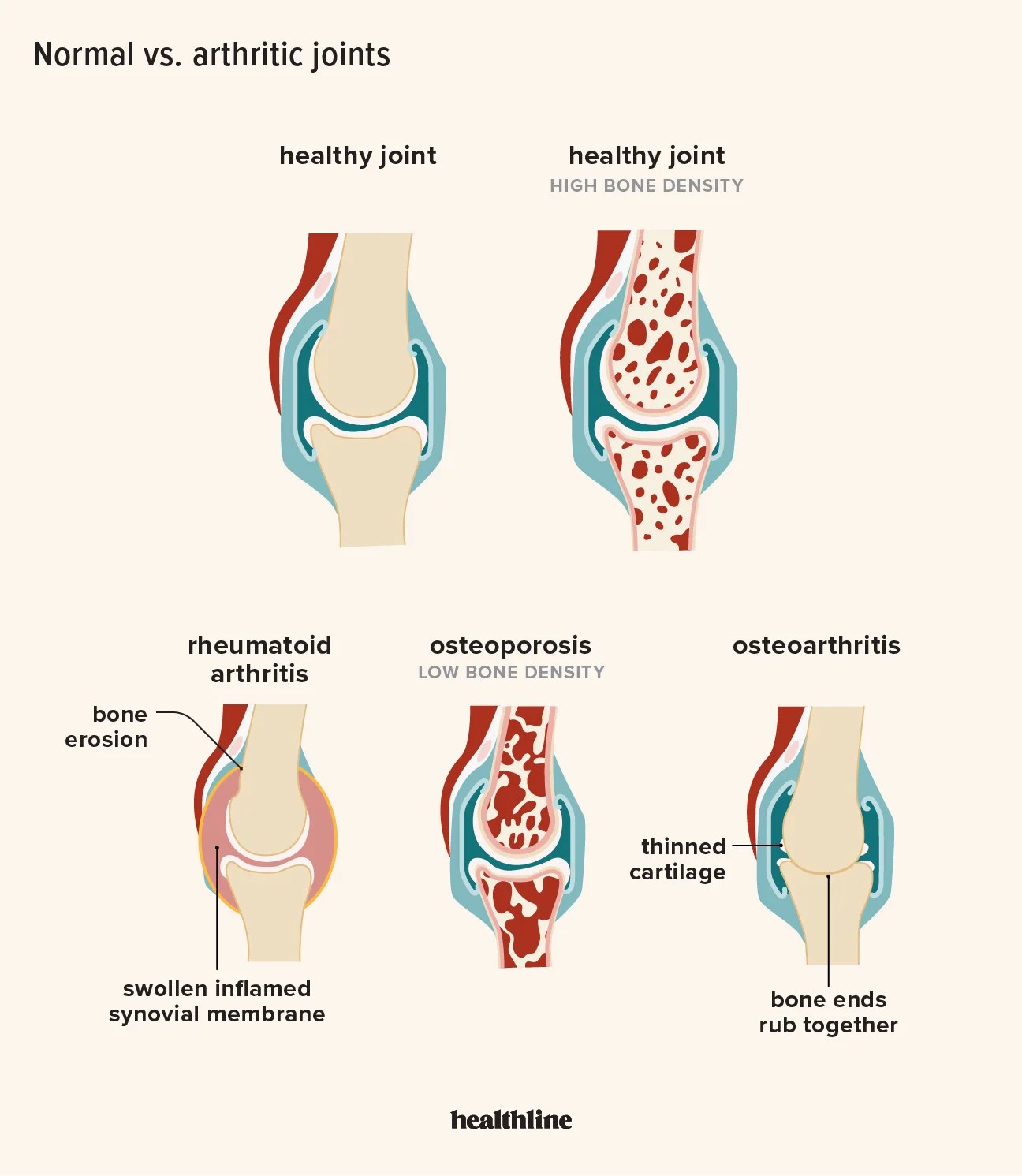 6 Home Remedies For Osteoarthritis