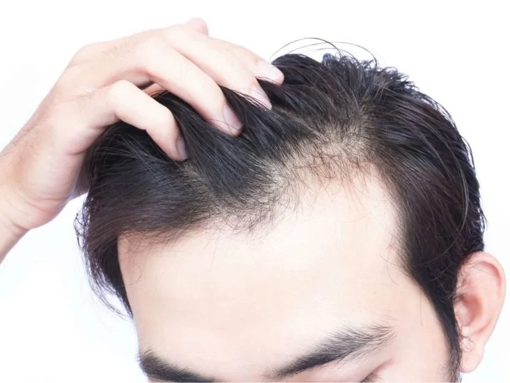 Hair Loss The Latest Research On Causes And Treatments