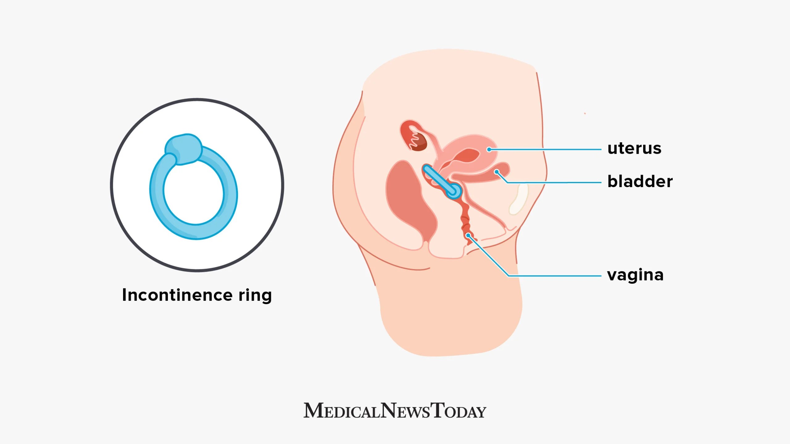an infographic of a Incontinence ring pessary