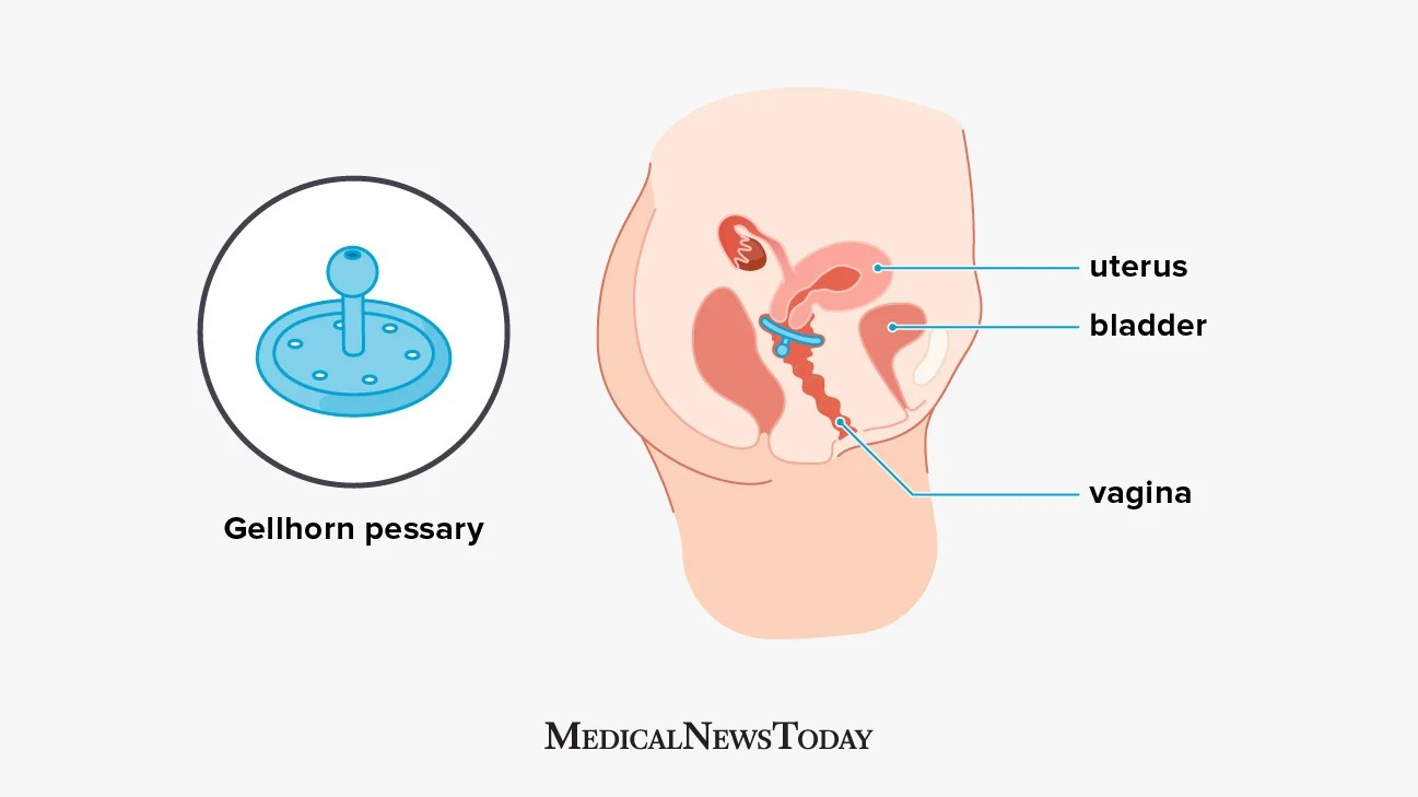 an infographic of a Gellhorn pessary