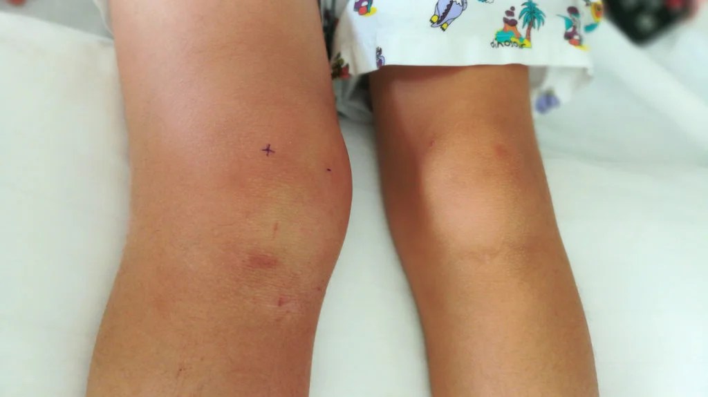 How To Reduce Swelling In The Knee Quickly Methods And Seeking Help