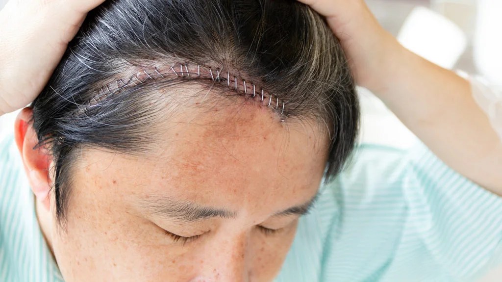 Craniotomy What Is It And Is It Different From Craniectomy
