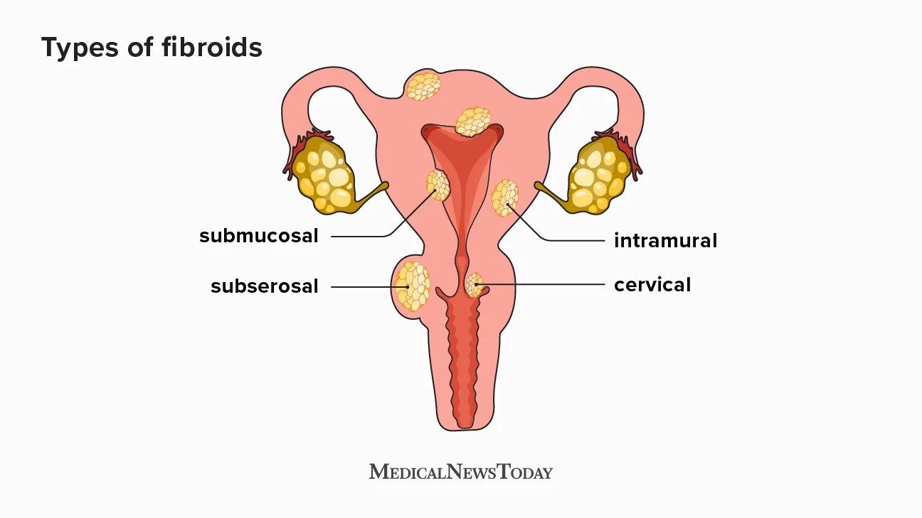 Types of fibroids infographic