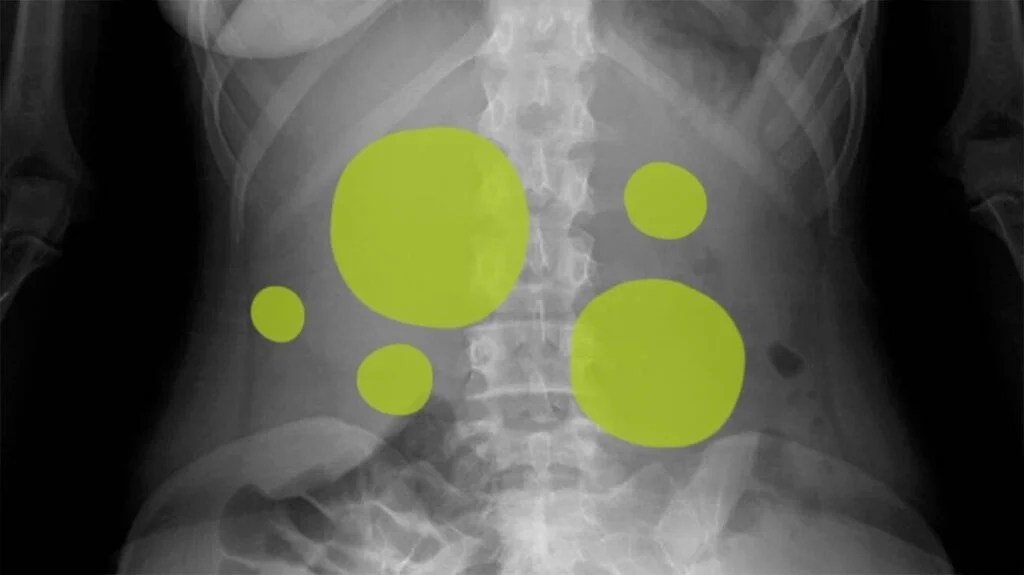 Gas In Stomach Symptoms Causes And Treatments