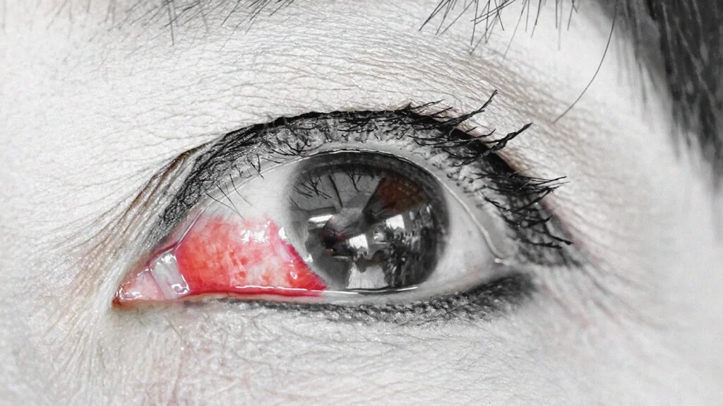 Eye Bleeding Types Causes Treatment And Seeking Help