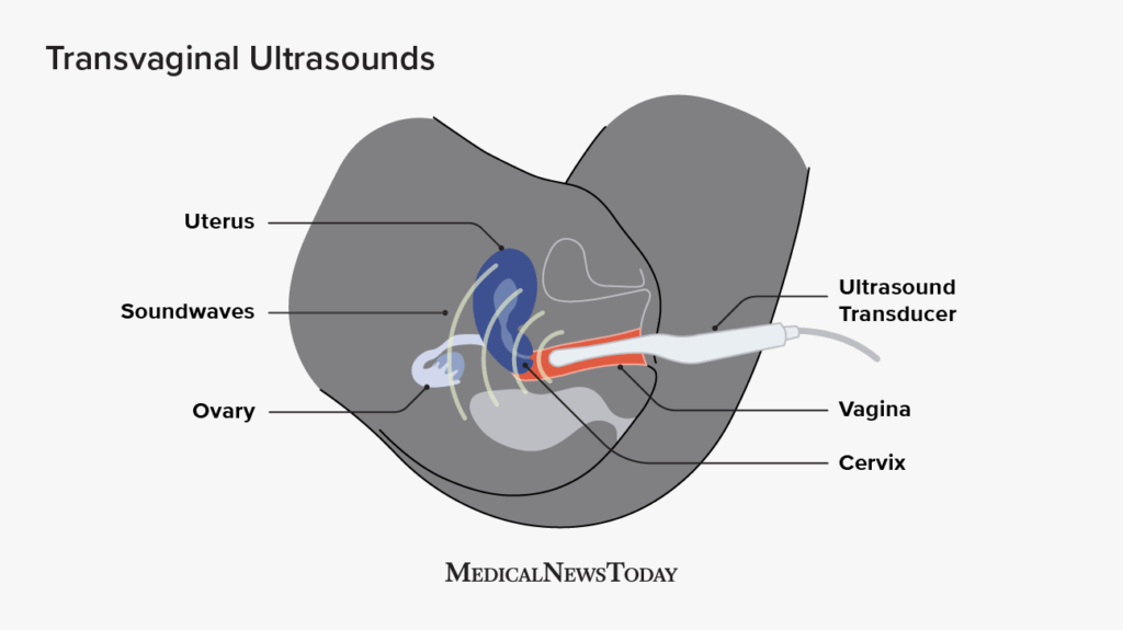 Transvaginal ultrasound illustration