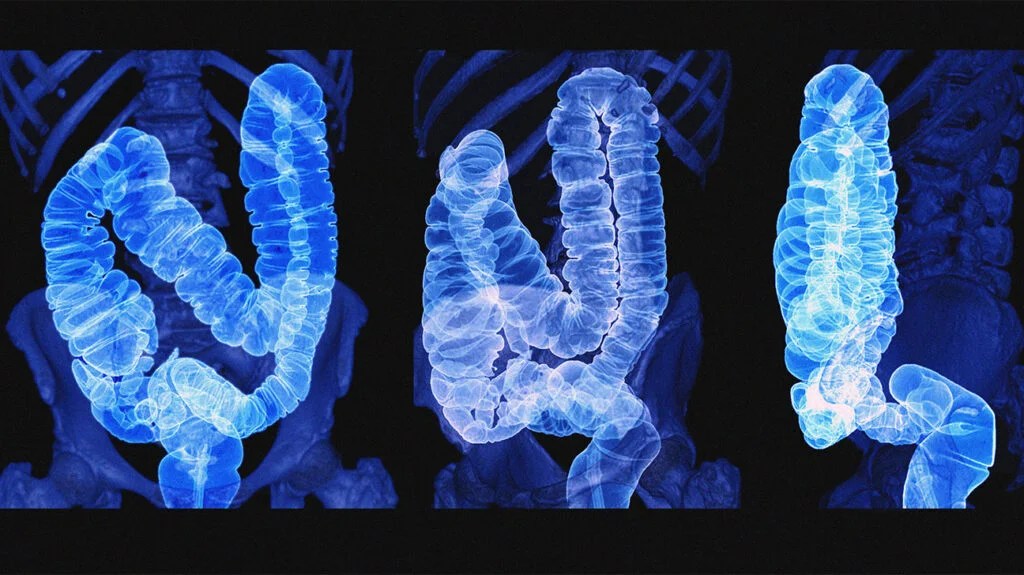 Colon Cancer Symptoms Stages Causes And Treatment