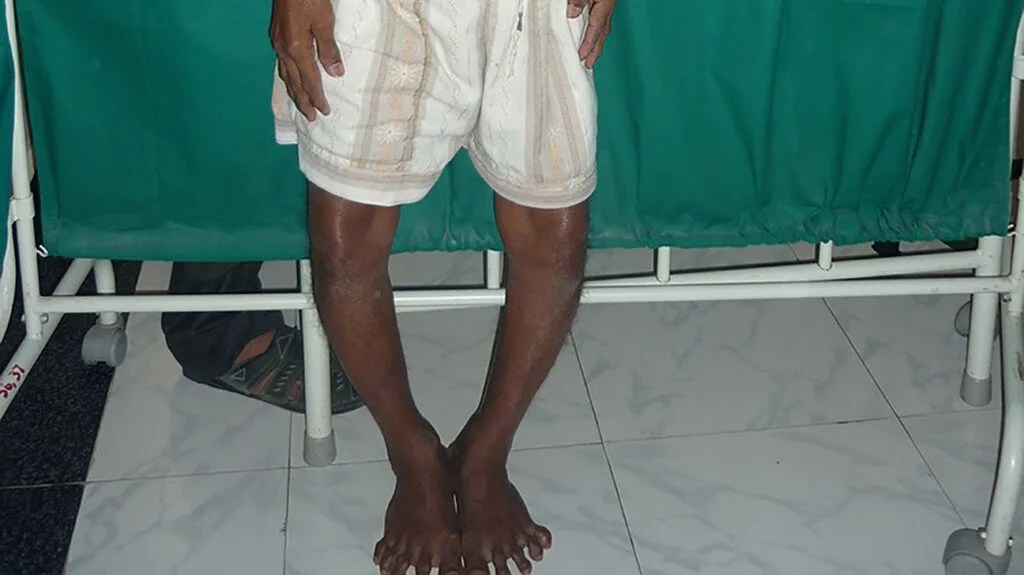 Knock Knees Genu Valgum Treatment Causes And Exercises