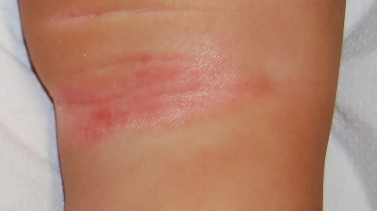 Inverse Psoriasis Causes Symptoms And More