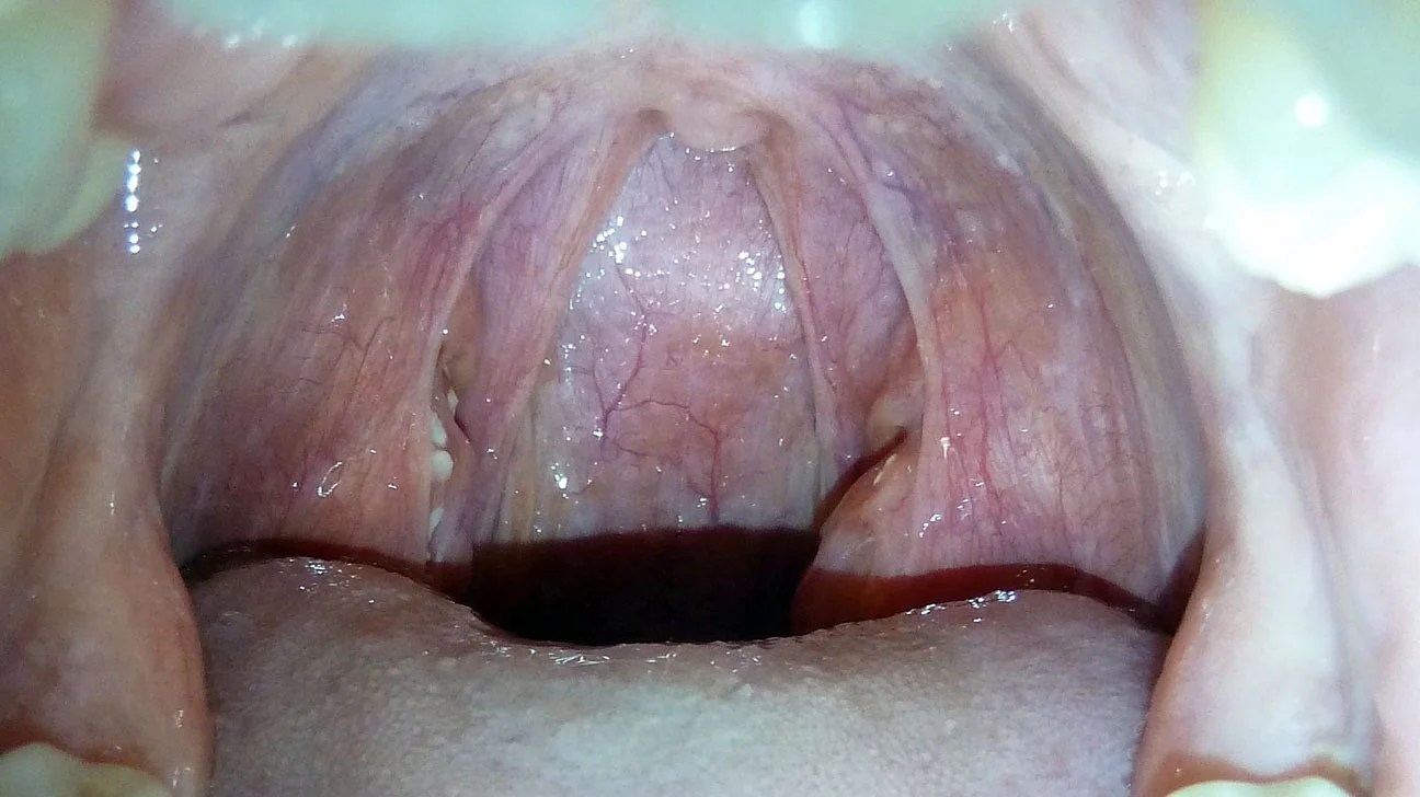 What Causes White Spots On The Tonsils