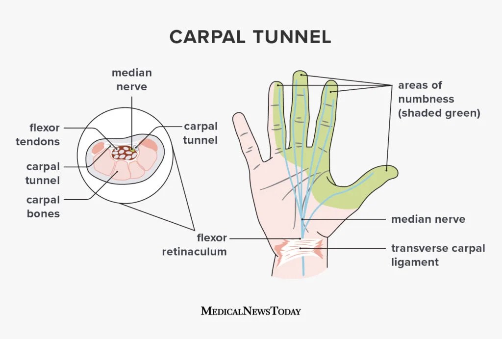 diagram of a hand explaining the symptoms and causes of carpal tunnel