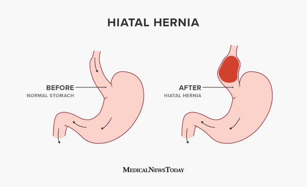 Hiatal Hernia Surgery Procedure Recovery And Outlook