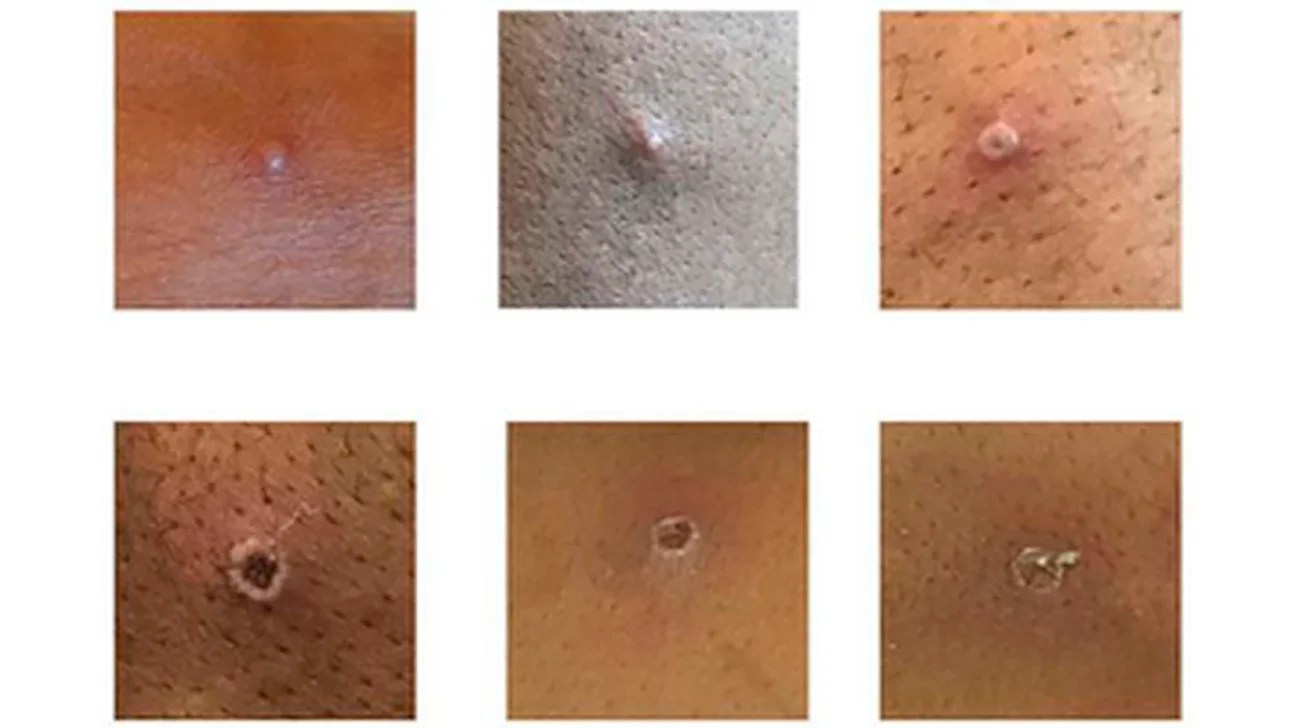 Monkeypox Virus Symptoms Outbreaks And Treatment
