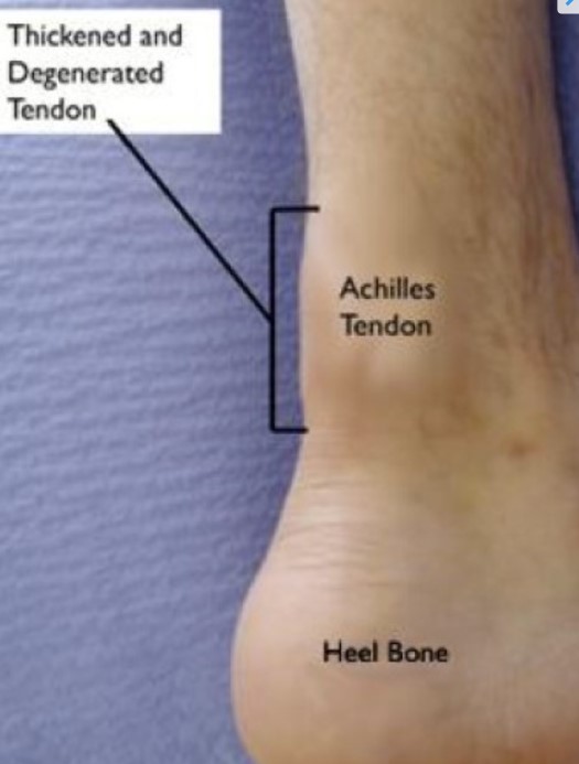 Achilles Tendonitis Bump