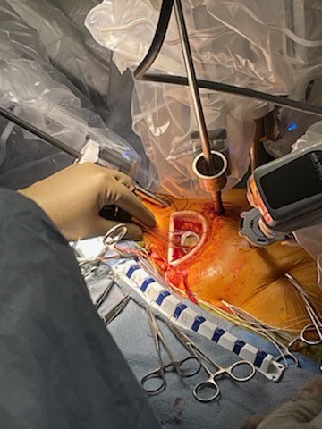 Robotic Aortic Valve Replacement With Percutaneous Cannulation